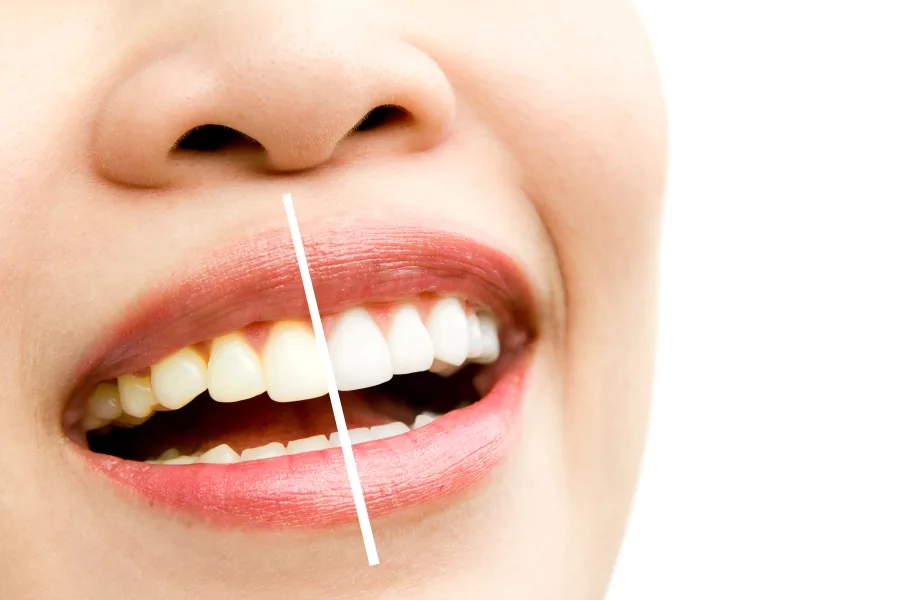 Clareamento dental combinado na Belle Dent, em Ibipeba