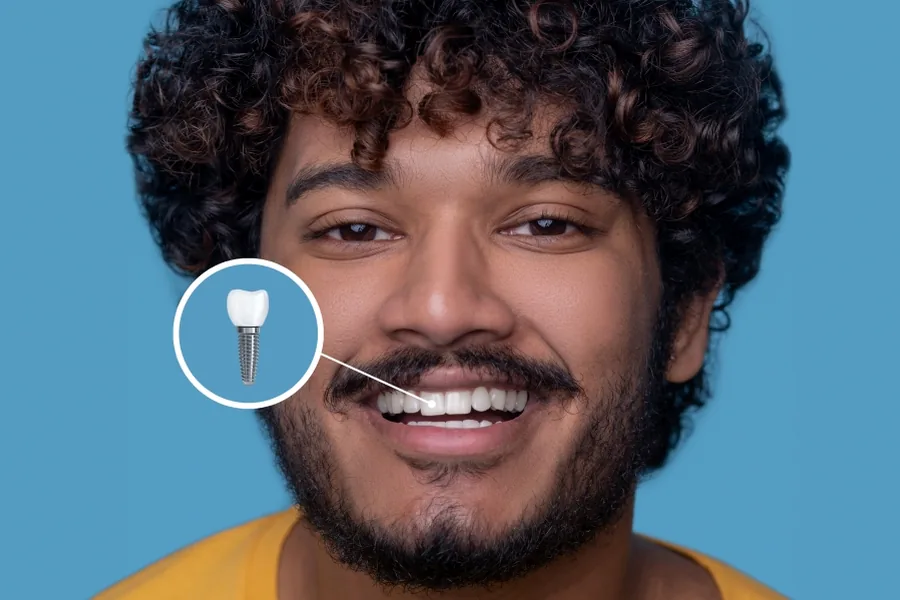 Implantes dentários com carga imediata na Belle Dent, em Ibipeba